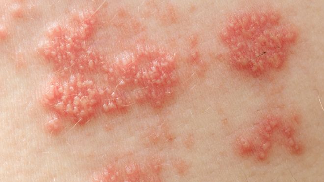 shingles-istock